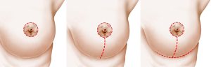 Breast Lift Incision Types