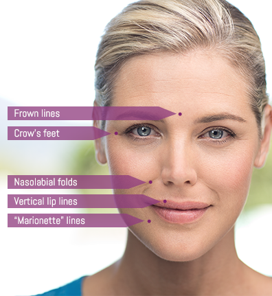The 4-Minute Rule for Juvederm - Jefferson University Hospitals thumbnail