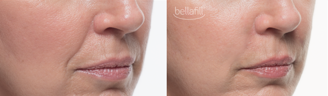 bellafill by Kole Plastic Surgery