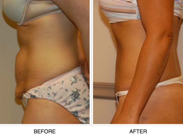 before and after of tummy tuck procedure