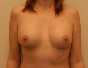 after breast augmentation