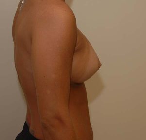 after breast augmentation