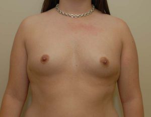 before breast augmentation