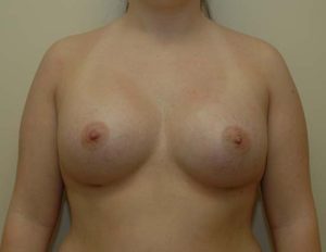 after breast augmentation