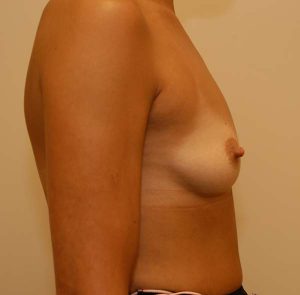 before breast augmentation