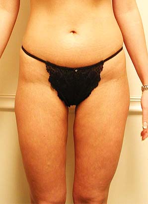 Liposuction of the hips and thighs after the procedure