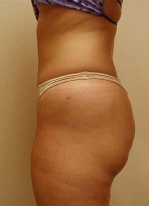 after liposuction of the hips and lower abdomen