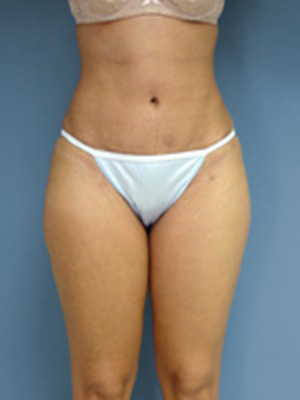 after liposuction of abdomen