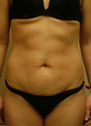 before the liposuction of abdomen procedure