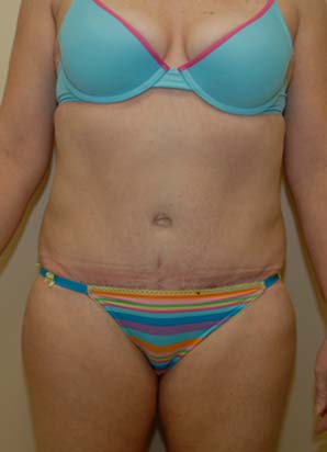 after the liposuction of abdomen procedure