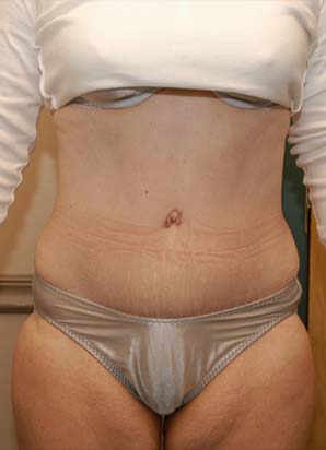 after the liposuction of abdomen procedure