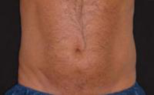 after male coolsculpting