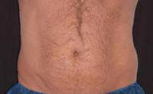 before male coolsculpting