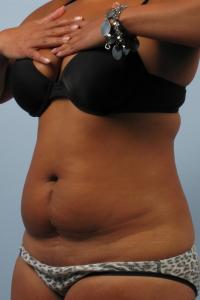 before coolSculpting to lower abdomen
