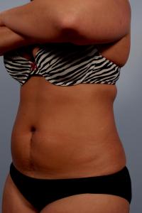 after coolSculpting to lower abdomen