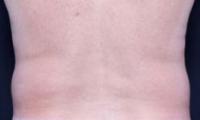 before coolsculpting procedure - male love handles posterior view
