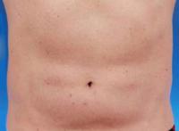 after coolsculpting procedure - male lower abdomen