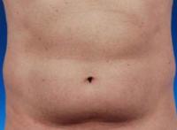 Male lower abdomen surgery