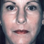 an image of a woman before undergoing a facelift