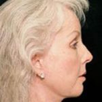 an image of face after facial surgery at Kole Plastic Surgery Center