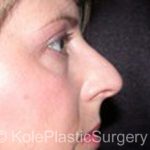 an image of face before facial surgery at Kole Plastic Surgery Center