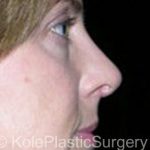 an image of face after facial surgery at Kole Plastic Surgery Center