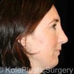 an image of face after facial surgery at Kole Plastic Surgery Center