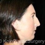 an image of face before facial surgery at Kole Plastic Surgery Center