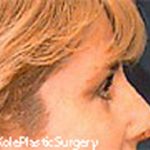 an image of face after facial surgery at Kole Plastic Surgery Center