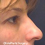 an image of face before facial surgery at Kole Plastic Surgery Center