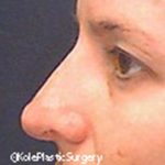 an image of face after facial surgery at Kole Plastic Surgery Center