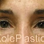 an image of face before facial surgery at Kole Plastic Surgery Center