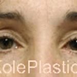 an image of face after facial surgery at Kole Plastic Surgery Center