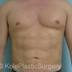 an image of a male's body after liposuction at Kole Plastic Surgery Center