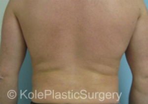 an image of men's back after liposuction