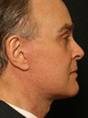 an image of men after facelift procedure