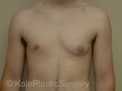 an image of male breast before breast reduction