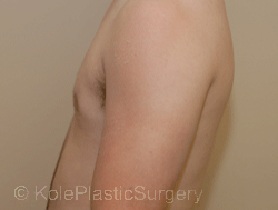 an image of male breast after breast reduction
