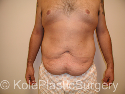 an image of men's tummy before tummy tuck procedure
