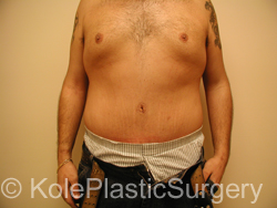 an image of men's tummy after tummy tuck procedure