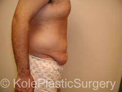 an image of men's tummy before tummy tuck procedure