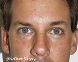 an image of men's eye after eyelid surgery