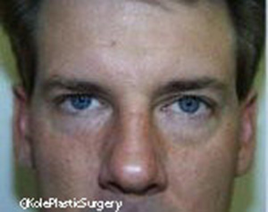 an image of men's eye before eyelid surgery