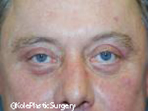 an image of men's eye after eyelid surgery