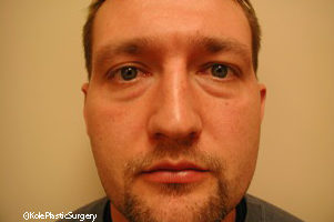 an image of men's eye before eyelid surgery