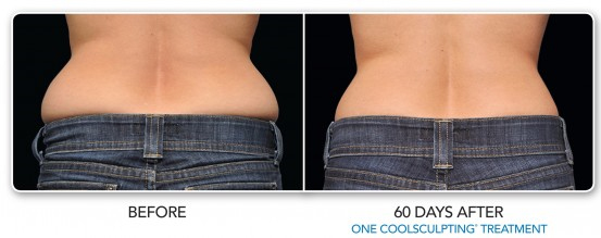CoolSculpting Before and After Pictures Philadelphia, PA