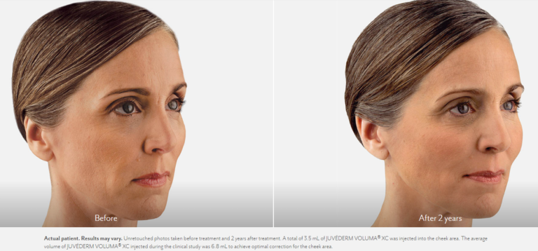 Juvederm Voluma™ near Philadelphia, PA