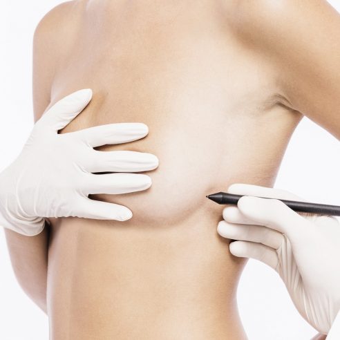 breast lift procedure at Kole Plastic Surgery