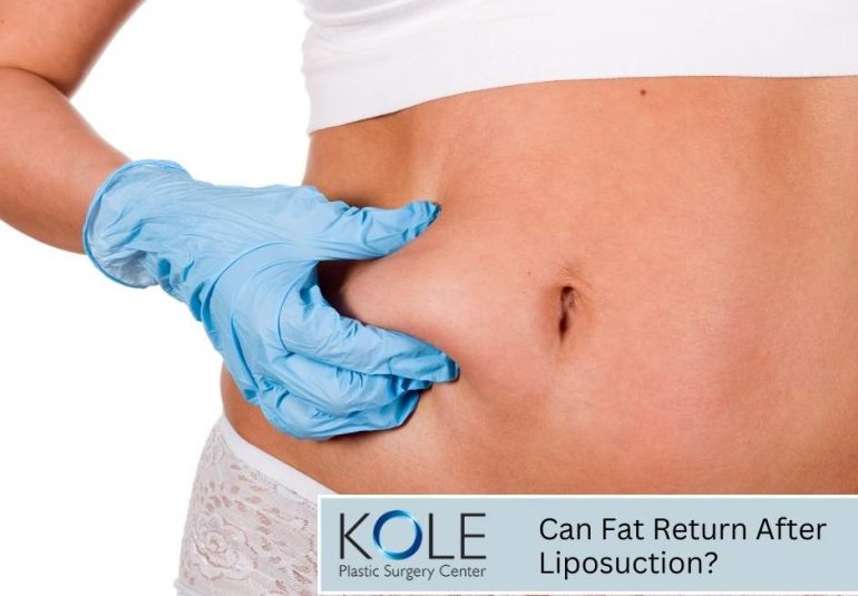 Can Fat Return After Liposuction?