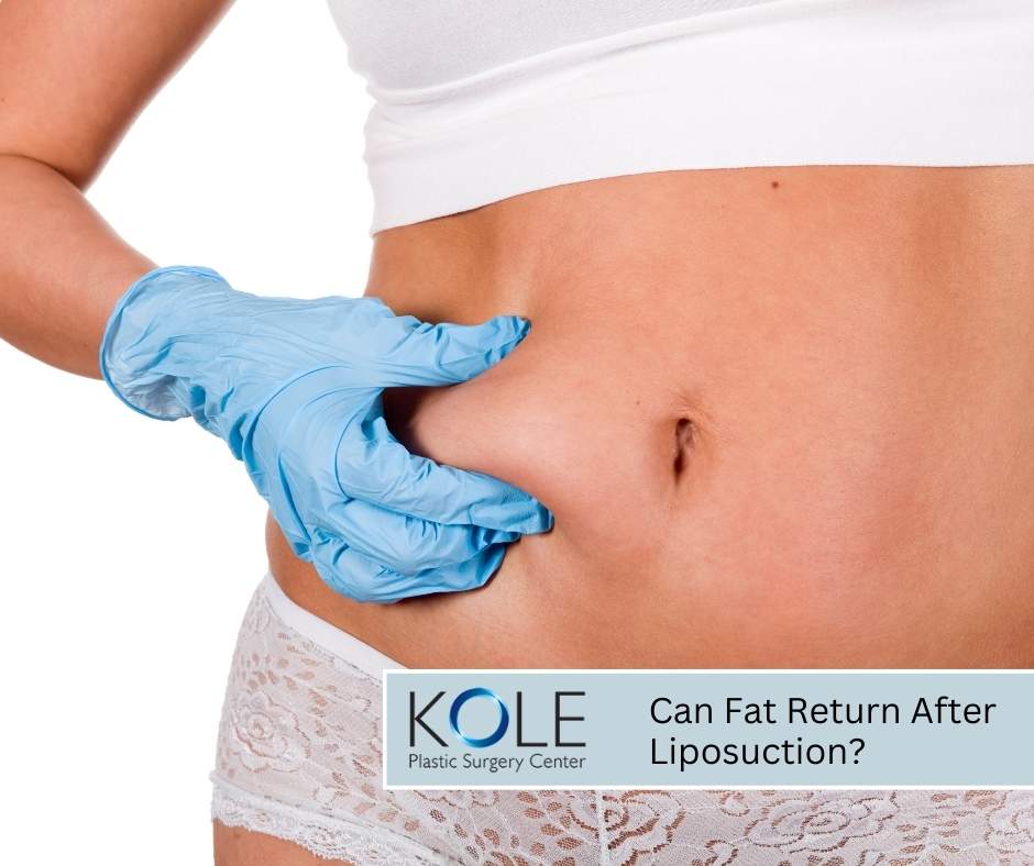 Can Fat Return After Liposuction?